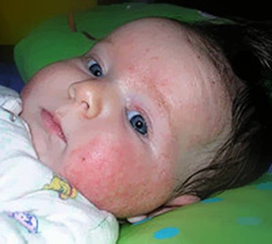 Сыпь при атопическом дерматите у детей фото