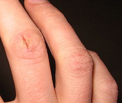 Трещины на пальцах рук